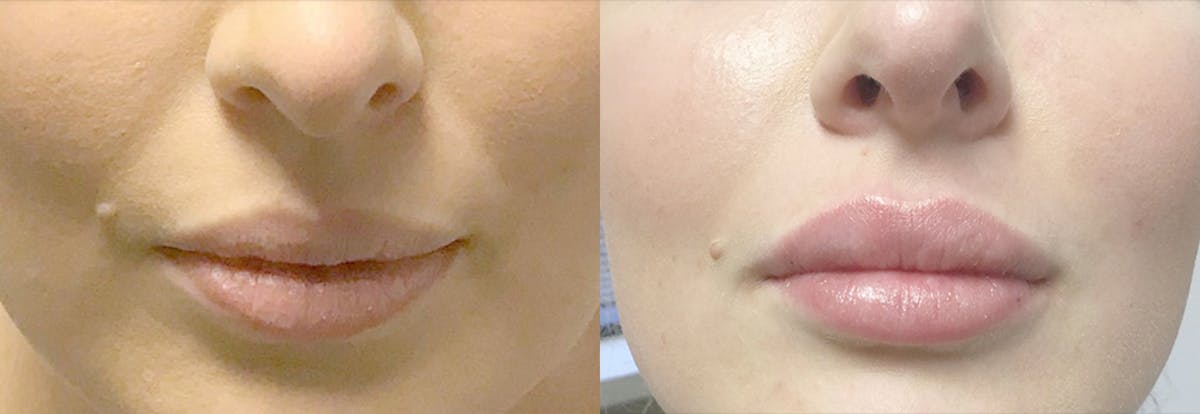 Lip Enhancement Before & After Gallery - Patient 141763 - Image 1