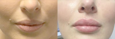 Lip Enhancement Before & After Gallery - Patient 141763 - Image 1