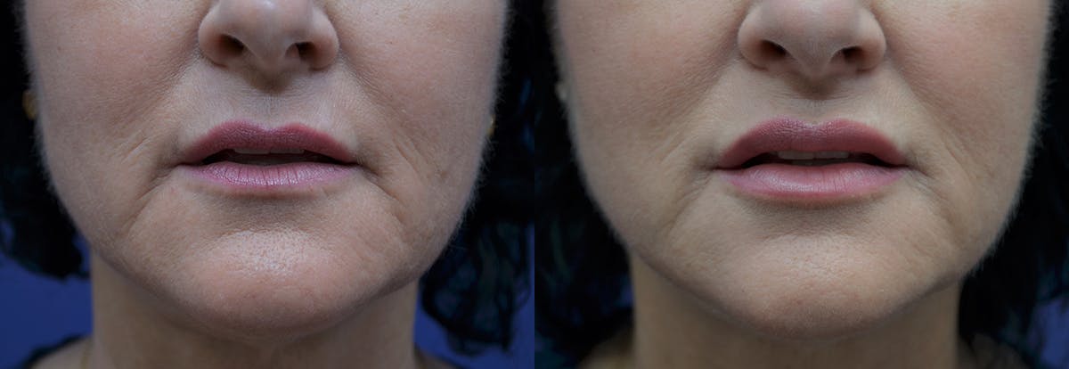 Lip Enhancement Before & After Gallery - Patient 247751 - Image 1