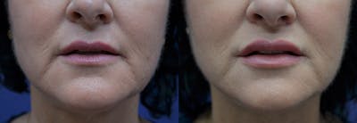Lip Enhancement Before & After Gallery - Patient 247751 - Image 1