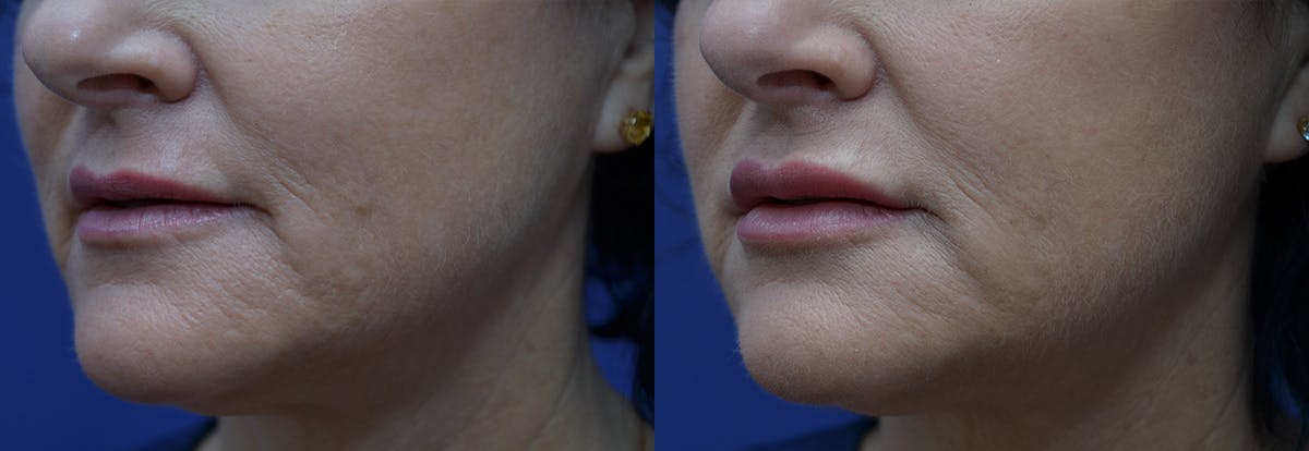 Lip Enhancement Before & After Gallery - Patient 247751 - Image 2