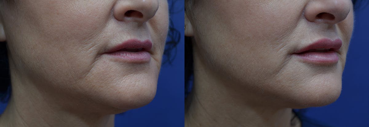 Lip Enhancement Before & After Gallery - Patient 247751 - Image 3