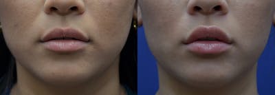 Lip Enhancement Before & After Gallery - Patient 135075 - Image 1