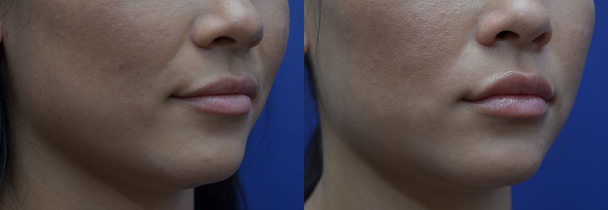 Lip Enhancement Before & After Gallery - Patient 135075 - Image 3