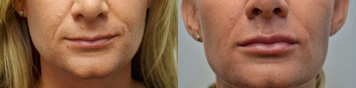 Lip Enhancement Before & After Gallery - Patient 205110 - Image 1