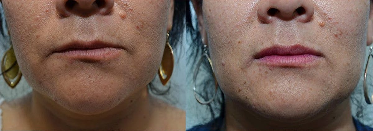 Lip Enhancement Before & After Gallery - Patient 486741 - Image 1