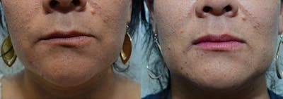 Lip Enhancement Before & After Gallery - Patient 486741 - Image 1
