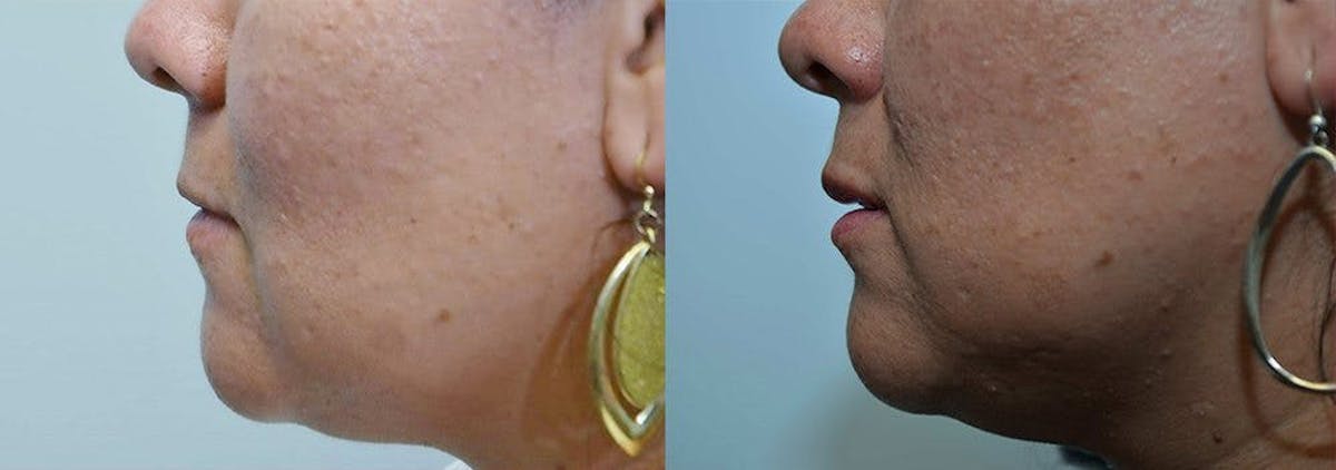 Lip Enhancement Before & After Gallery - Patient 486741 - Image 2