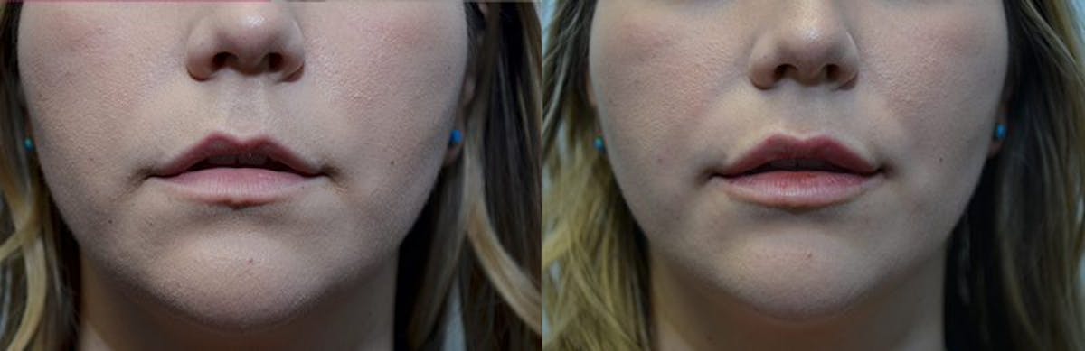 Lip Enhancement Before & After Gallery - Patient 318975 - Image 1