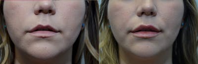 Lip Enhancement Before & After Gallery - Patient 318975 - Image 1
