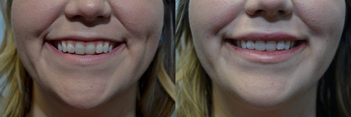 Lip Enhancement Before & After Gallery - Patient 318975 - Image 2