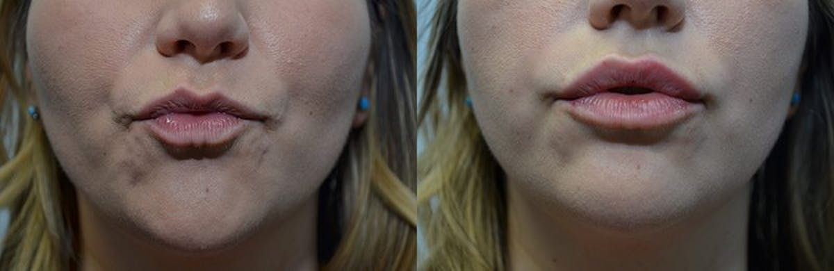 Lip Enhancement Before & After Gallery - Patient 318975 - Image 3