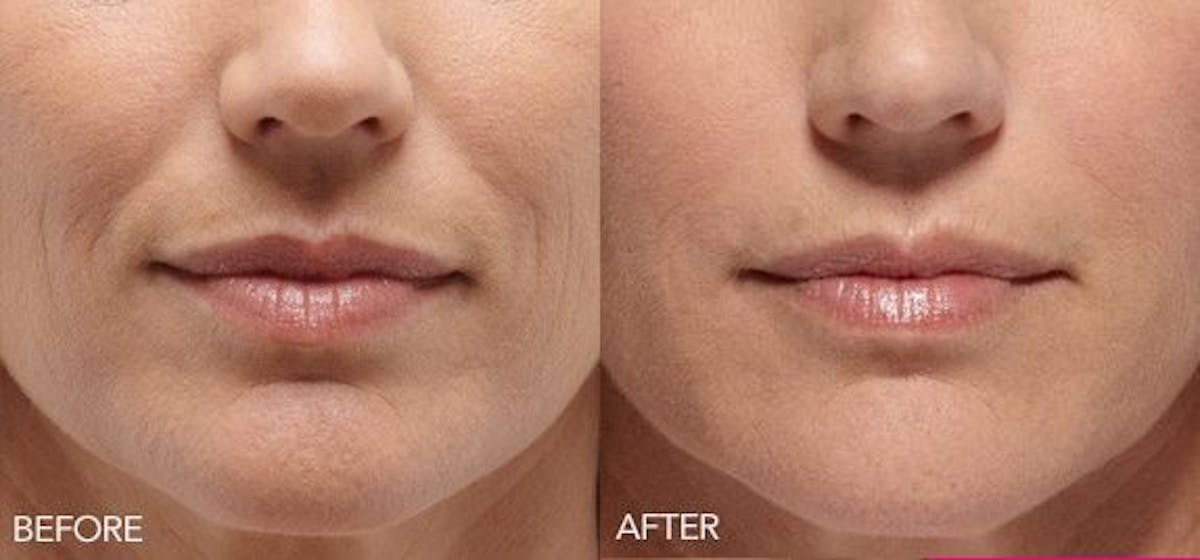 Lip Enhancement Before & After Gallery - Patient 319039 - Image 1