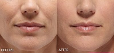 Lip Enhancement Before & After Gallery - Patient 319039 - Image 1