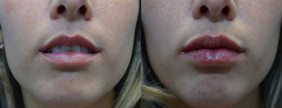 Lip Enhancement Before & After Gallery - Patient 204118 - Image 1
