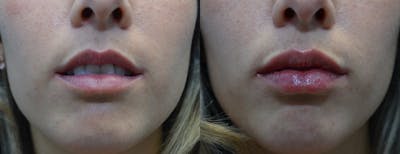Lip Enhancement Before & After Gallery - Patient 204118 - Image 1