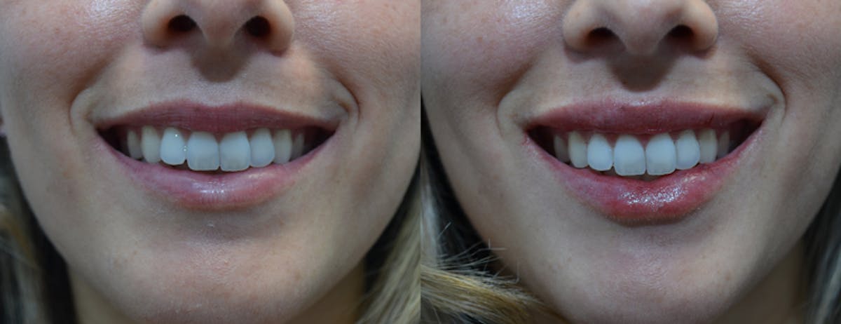 Lip Enhancement Before & After Gallery - Patient 204118 - Image 2