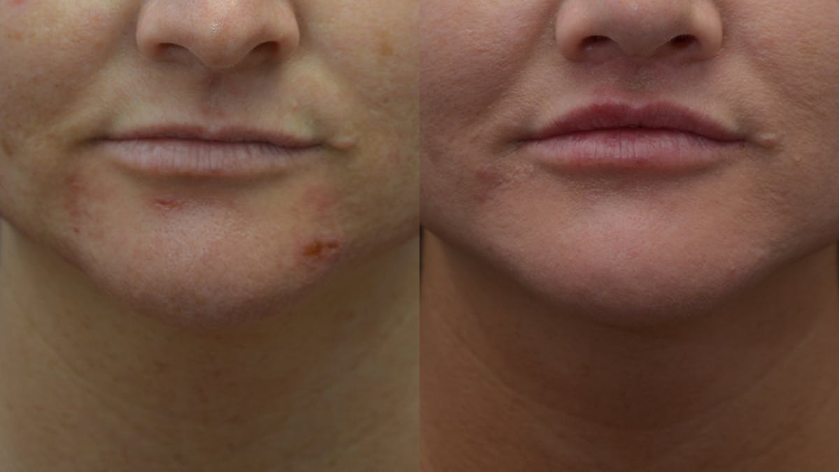 Lip Enhancement Before & After Gallery - Patient 219631 - Image 1