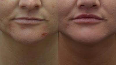 Lip Enhancement Before & After Gallery - Patient 219631 - Image 1