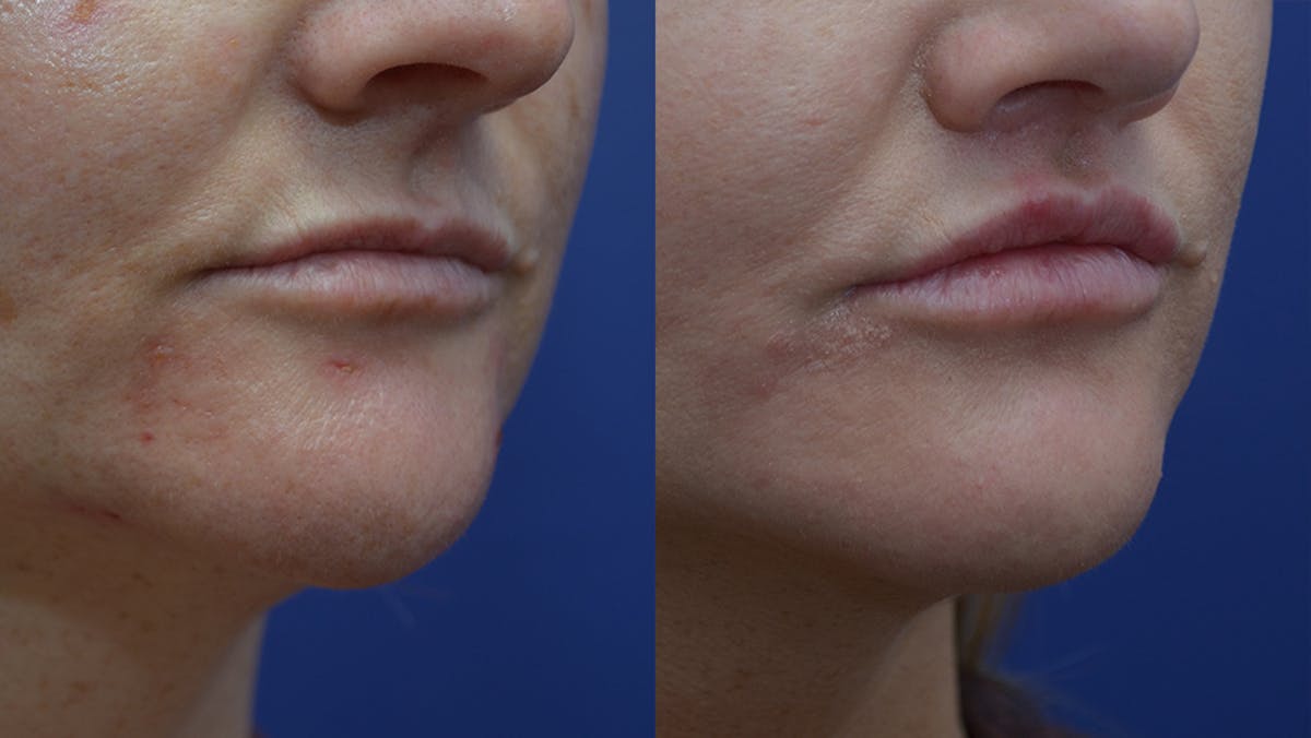Lip Enhancement Before & After Gallery - Patient 219631 - Image 2