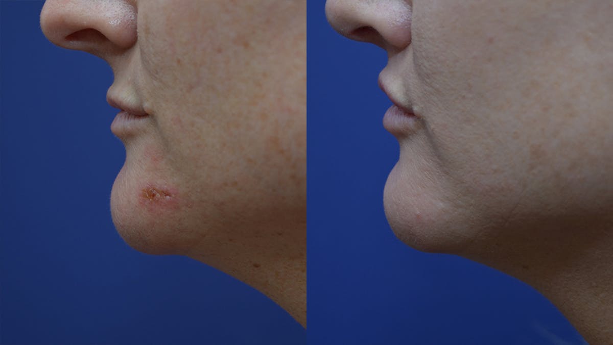 Lip Enhancement Before & After Gallery - Patient 219631 - Image 3