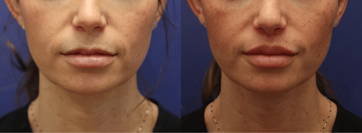 Lip Augmentation Before & After Gallery - Patient 254278 - Image 1