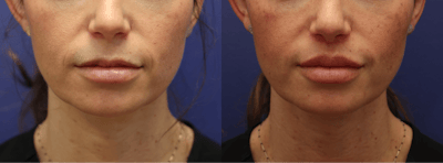 Lip Lift / Lip Augmentation Before & After Gallery - Patient 158844 - Image 1