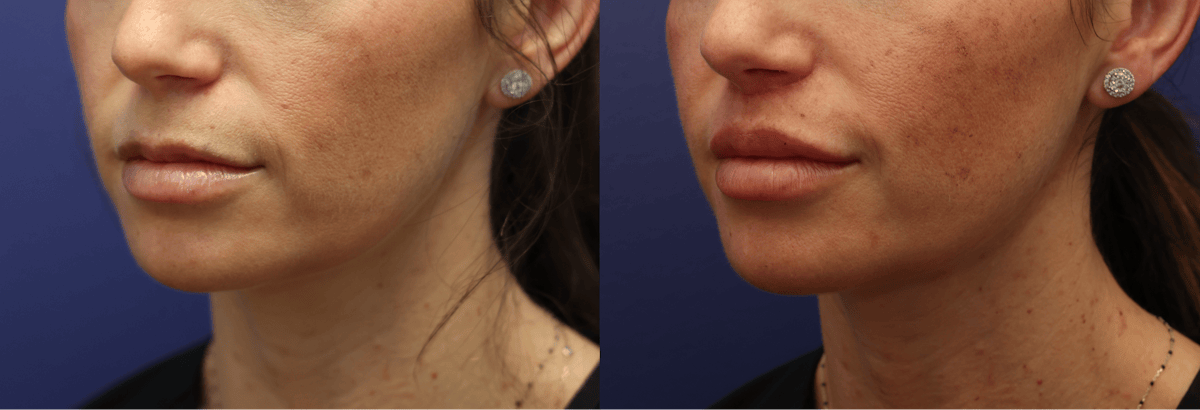 Lip Augmentation Before & After Gallery - Patient 254278 - Image 2