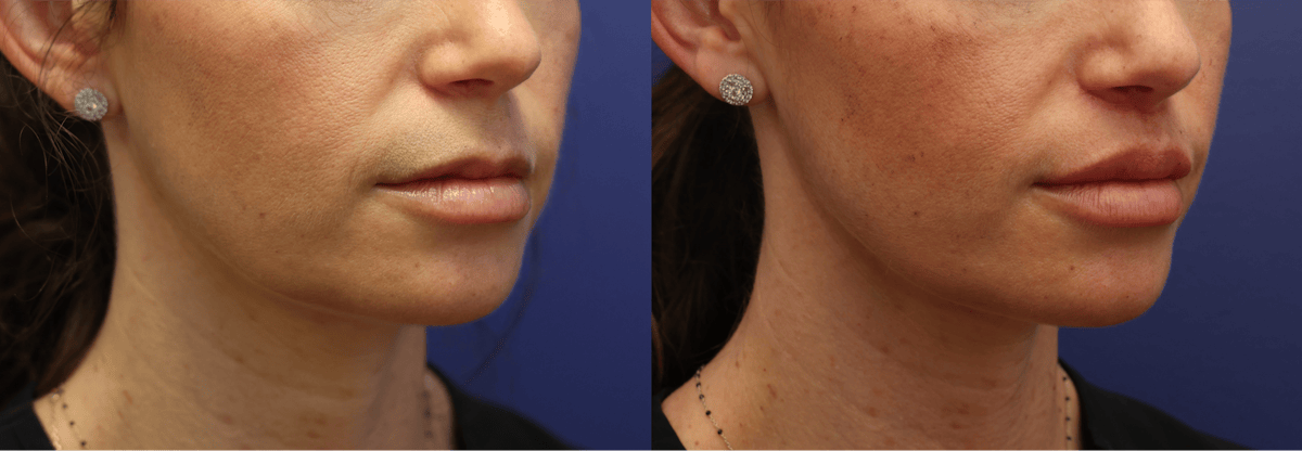 Lip Augmentation Before & After Gallery - Patient 254278 - Image 3