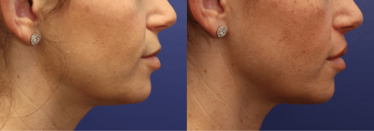 Lip Augmentation Before & After Gallery - Patient 254278 - Image 4