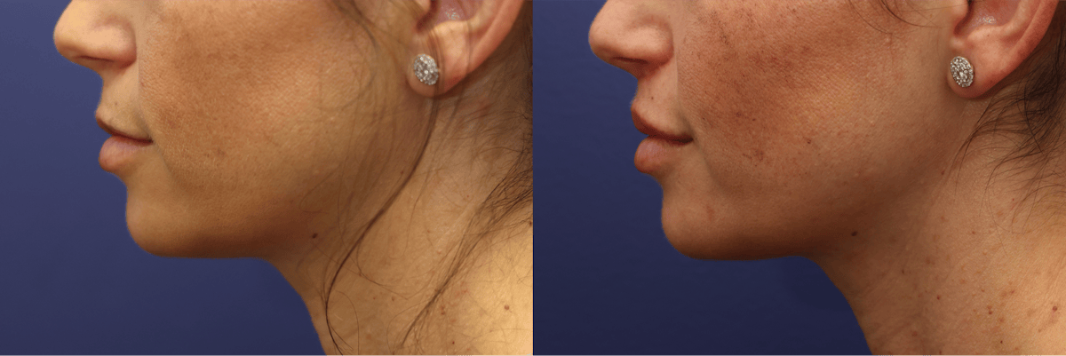 Lip Augmentation Before & After Gallery - Patient 254278 - Image 5