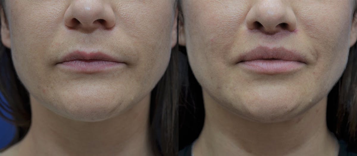 Lip Augmentation Before & After Gallery - Patient 947157 - Image 1