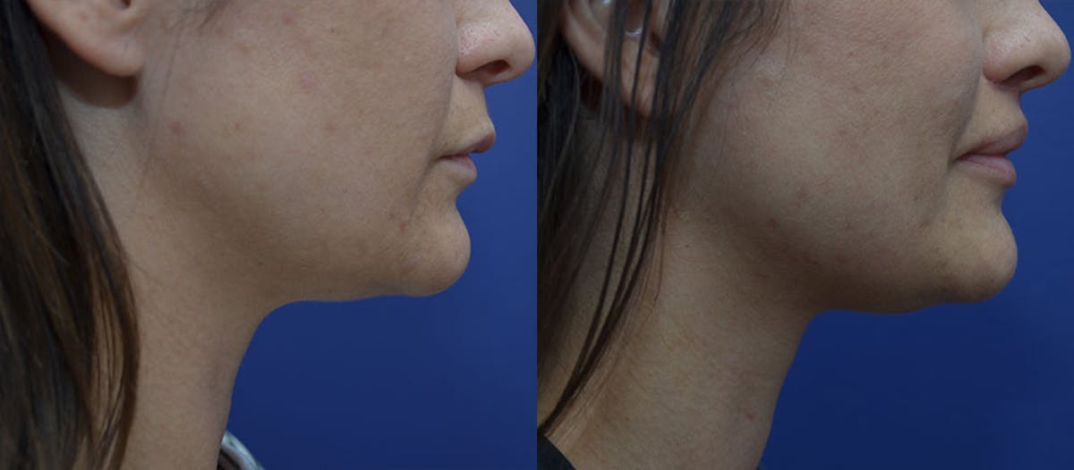Lip Augmentation Before & After Gallery - Patient 947157 - Image 3
