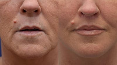 Lip Lift / Lip Augmentation Before & After Gallery - Patient 423083 - Image 1