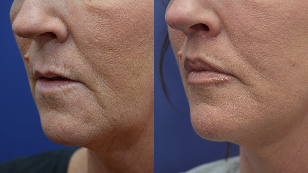 Lip Augmentation Before & After Gallery - Patient 385094 - Image 3