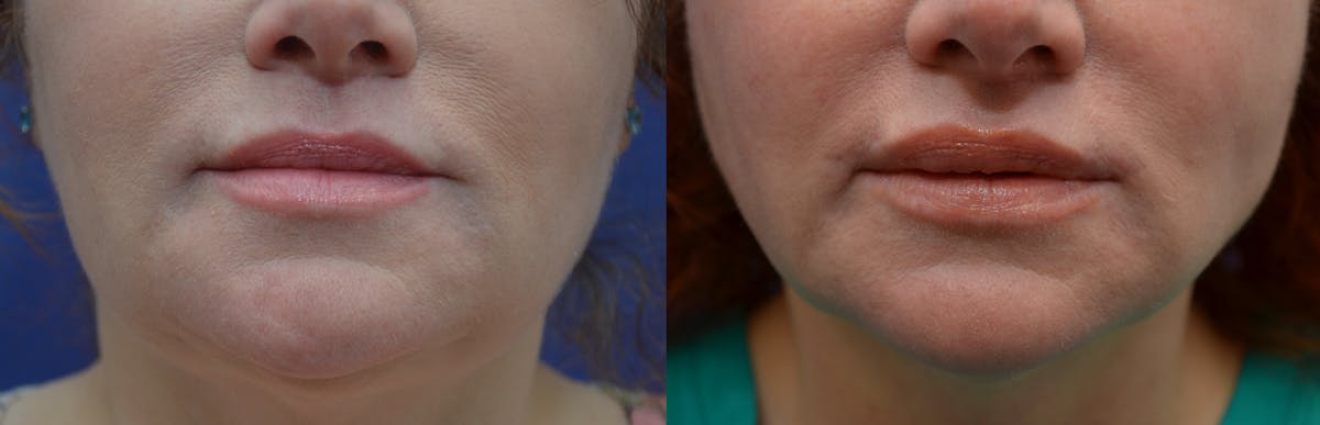 Lip Augmentation Before & After Gallery - Patient 899527 - Image 1