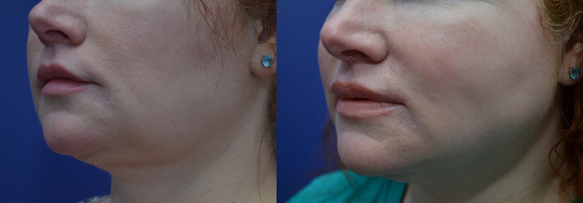Lip Augmentation Before & After Gallery - Patient 899527 - Image 2