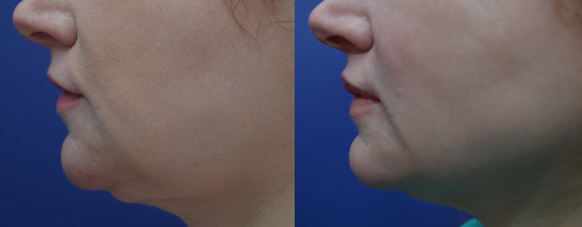 Lip Augmentation Before & After Gallery - Patient 899527 - Image 3