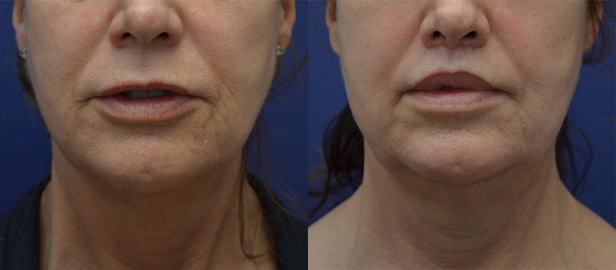 Lip Lift Before & After Gallery - Patient 204345 - Image 1