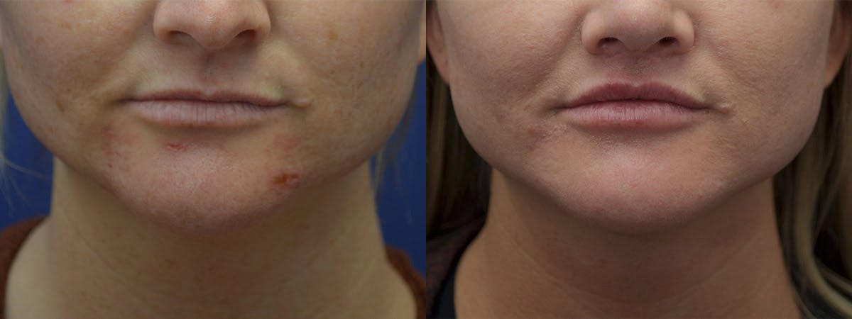 Lip Lift Before & After Gallery - Patient 254720 - Image 1
