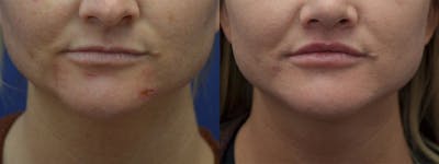 Lip Lift / Lip Augmentation Before & After Gallery - Patient 398725 - Image 1