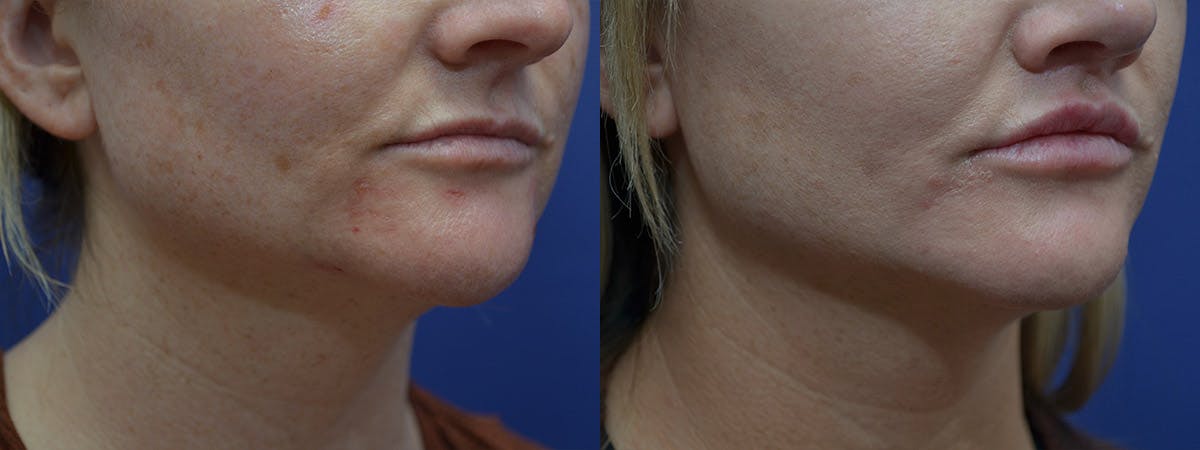 Lip Lift Before & After Gallery - Patient 254720 - Image 2