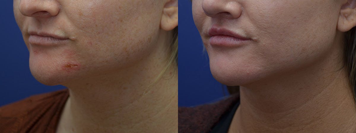Lip Lift Before & After Gallery - Patient 254720 - Image 3