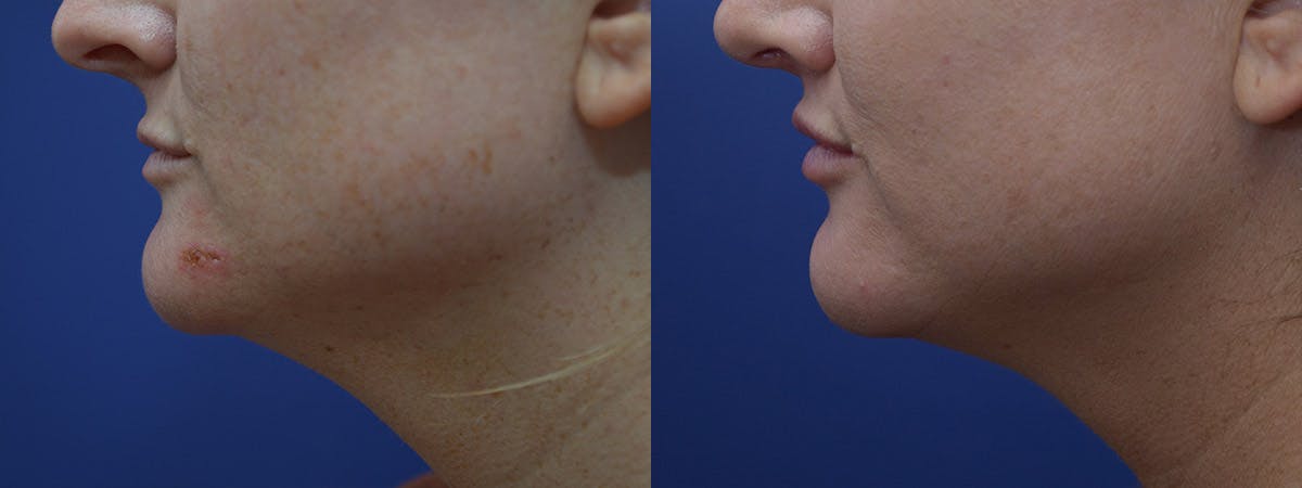 Lip Lift Before & After Gallery - Patient 254720 - Image 4