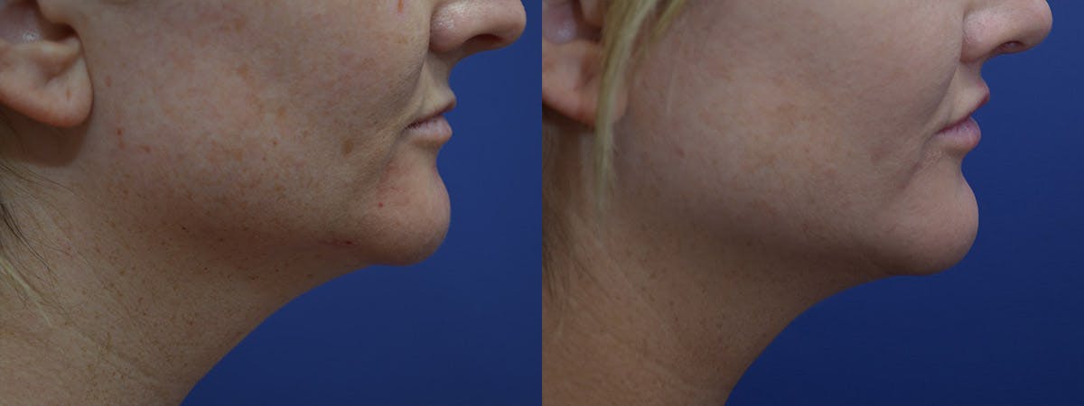 Lip Lift Before & After Gallery - Patient 254720 - Image 5