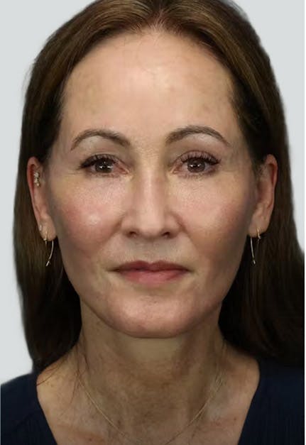 facelift after image
