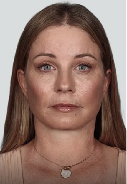 lipo after image