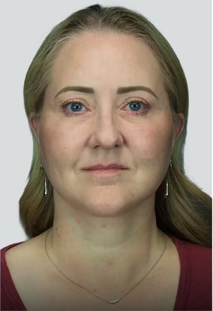 rhinoplasty after image