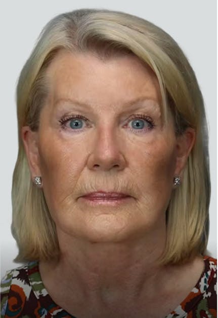 Deep Plane Facelift after image