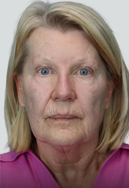 Deep Plane Facelift before image